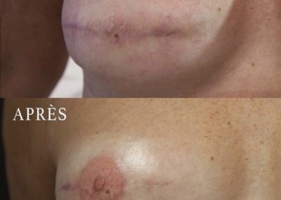 tatouage-reconstruction-mammaire