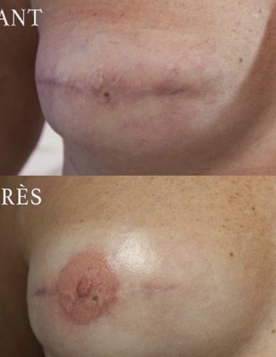 tatouage-reconstruction-mammaire